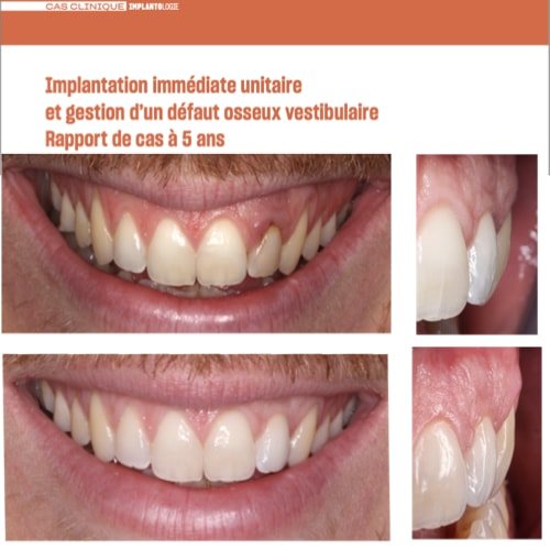 Implantation Unitaire Immediate et gestion d_un defaut osseux vestibulaire